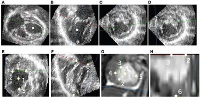 Regional Differences in End-Diastolic Volumes between 3D Echo and CMR in HLHS Patients